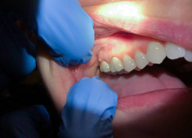 Best Broken or Cracked Tooth Emergency Dentist in Lemmon, SD